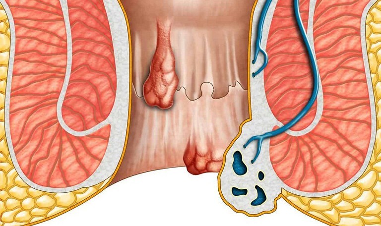 Triệu chứng của bệnh trĩ khi mang thai là gì?