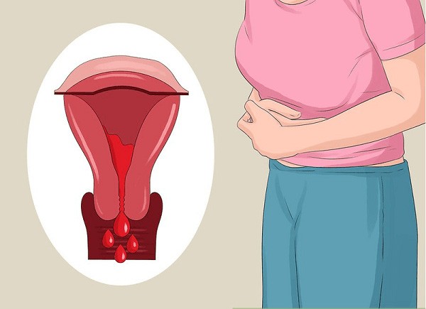 lieu-phap-hormone-utnmtc