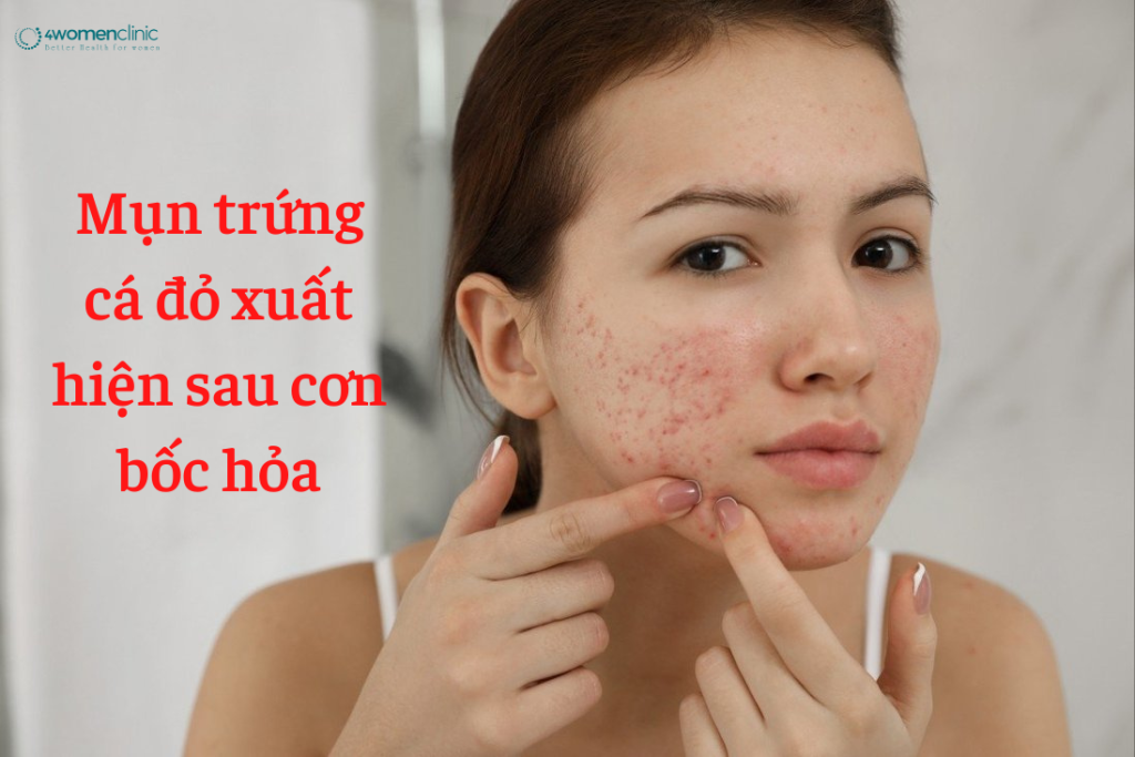 Mụn Trứng Cá đỏ Xuất Hiện Sau Cơn Bốc Hỏa