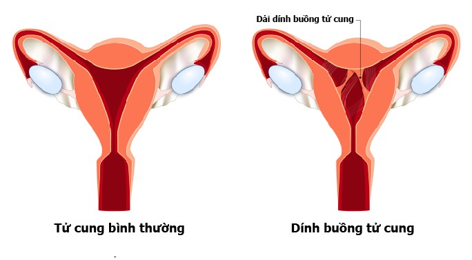 Dính buồng tử cung