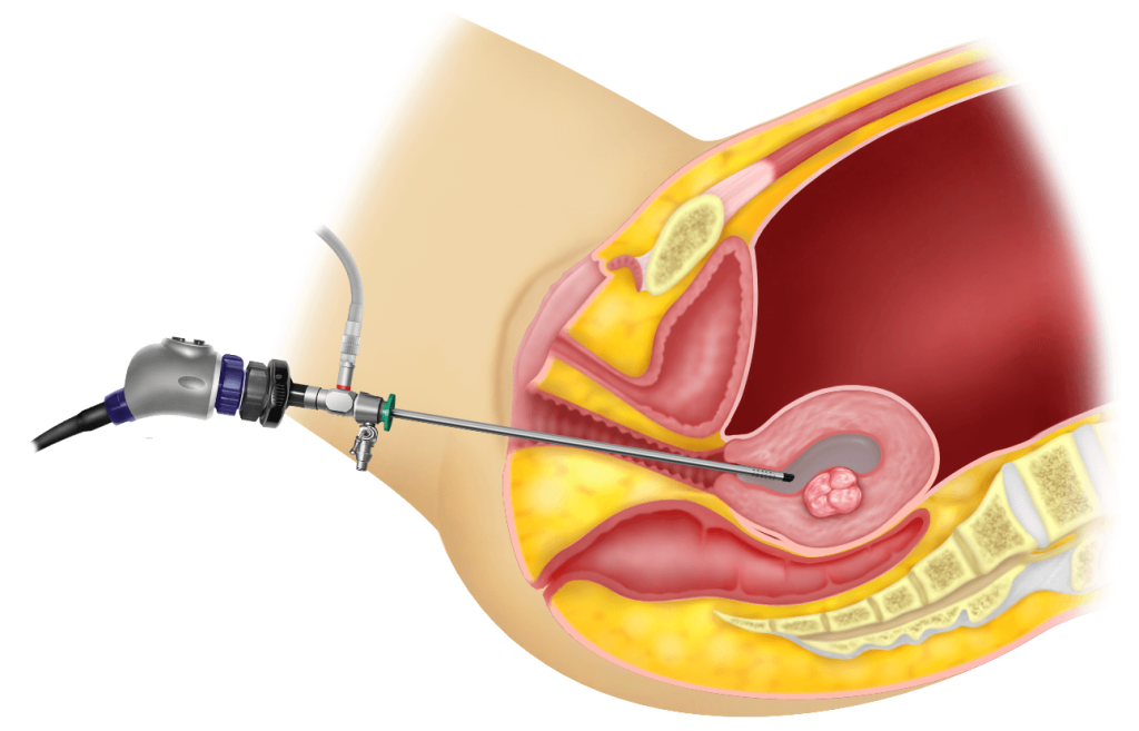 Figure 36.1 Diagnostic Hysteroscopy