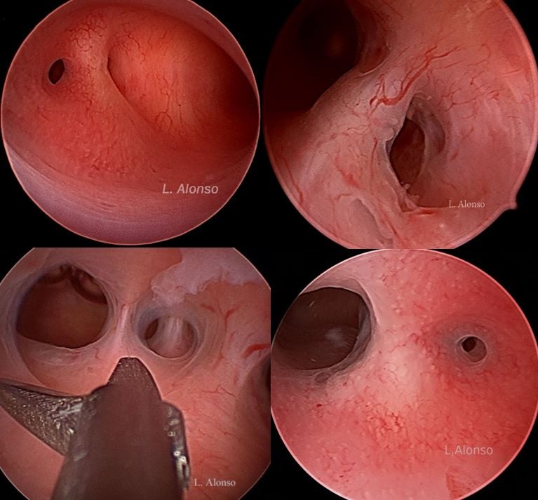 Adherencias Intrauterinas Copia