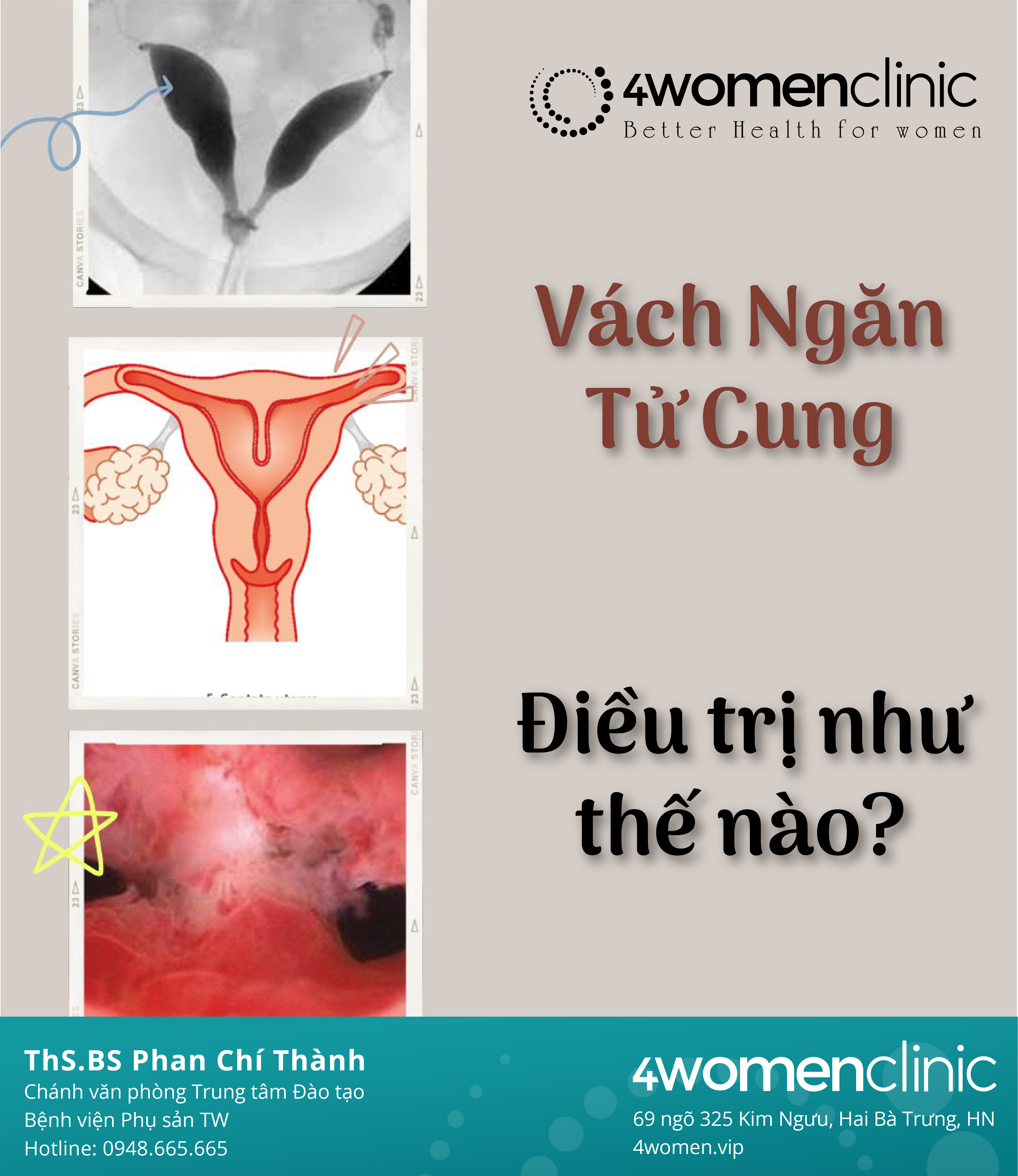 Điều Trị Vách Ngăn 01