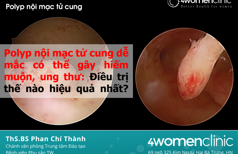 Polyp Nội Mạc 01