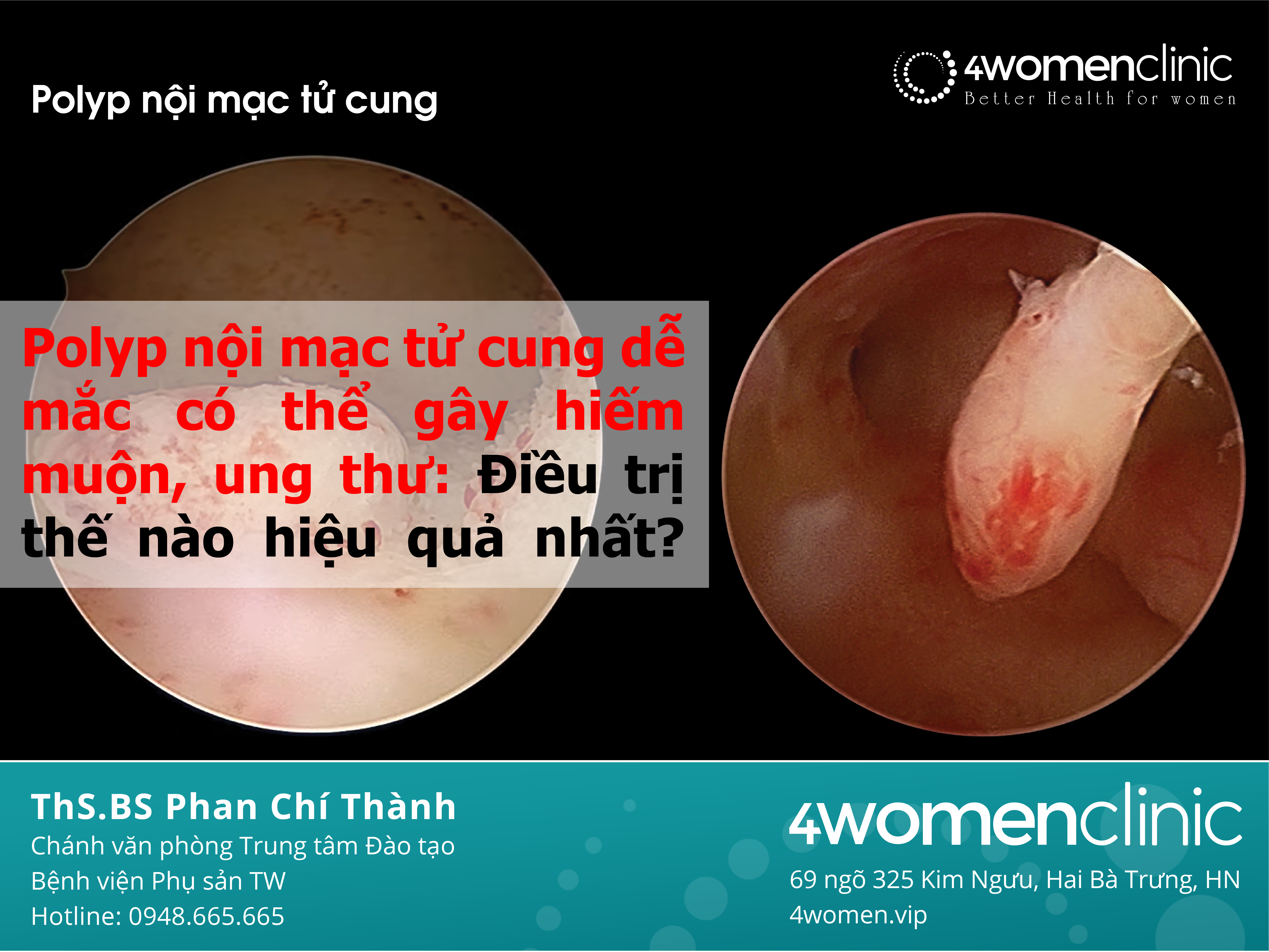 Polyp Nội Mạc 01