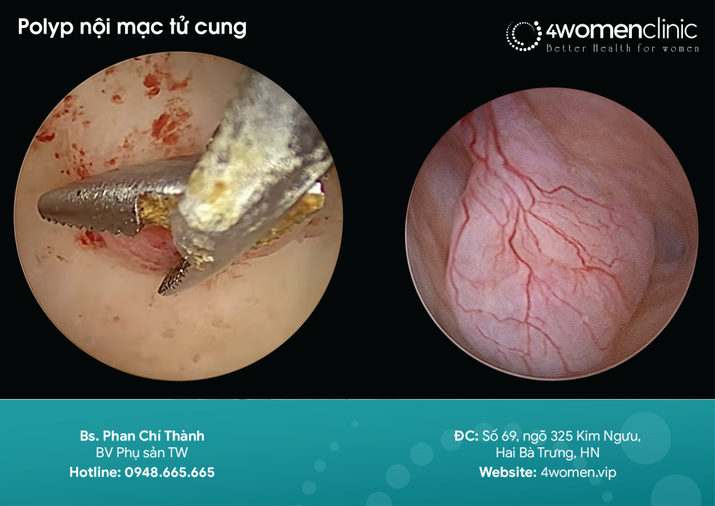 Polyp Nội Mạc Tc 2