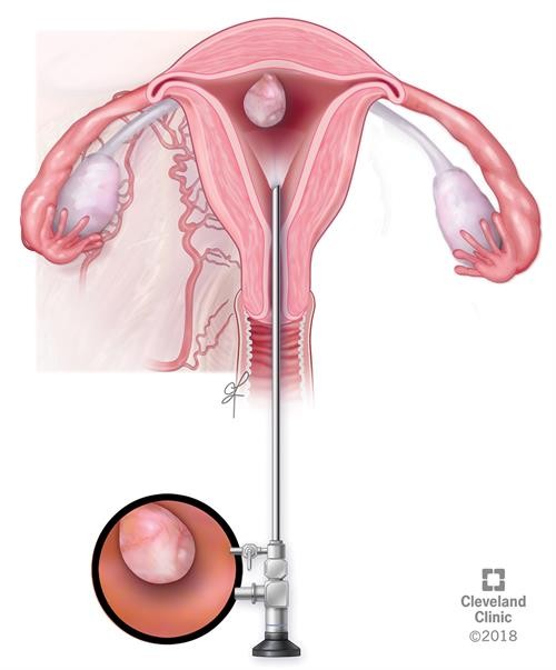 Soi Buồng Tử Cung Cắt Bỏ Polyp