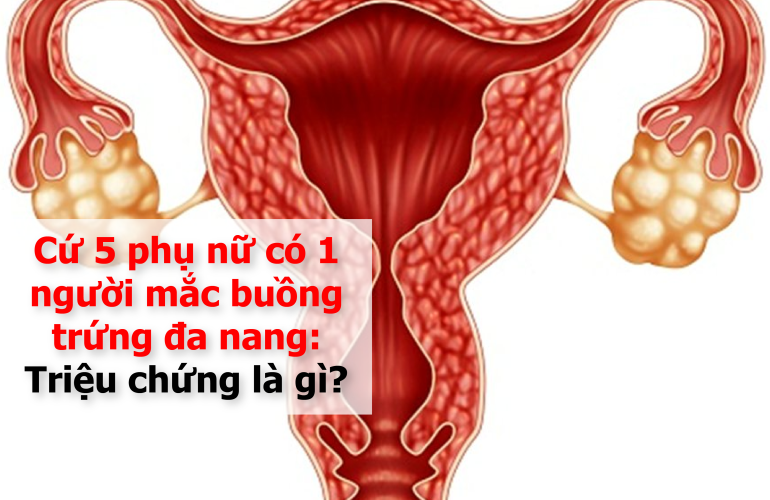 Triệu Chứng Pcos 01