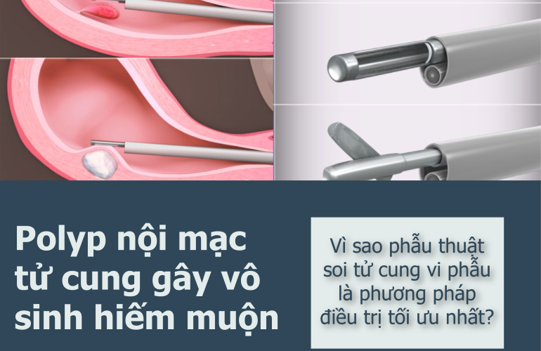 Vì Sao Phẫu Thuật Soi Tử Cung Vi Phẫu Là Phương Pháp điều Trị Tối ưu Nhất 01