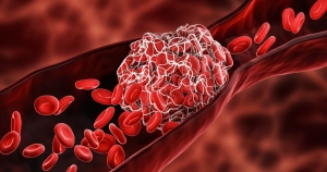 Blood Clot Istock 1297034329